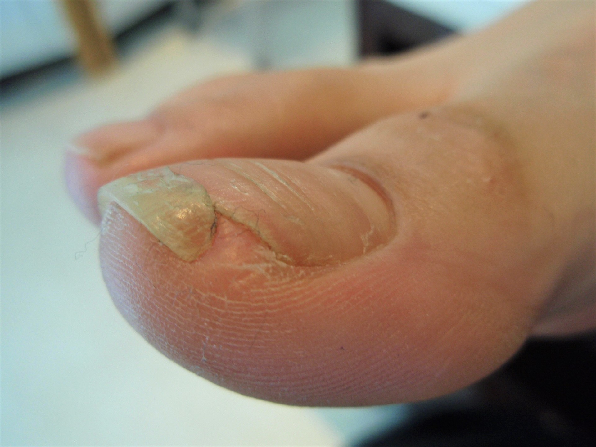 足の爪をカッターで薄く削った症例のつづき: 京子先生のネイルビューティーダイアリー